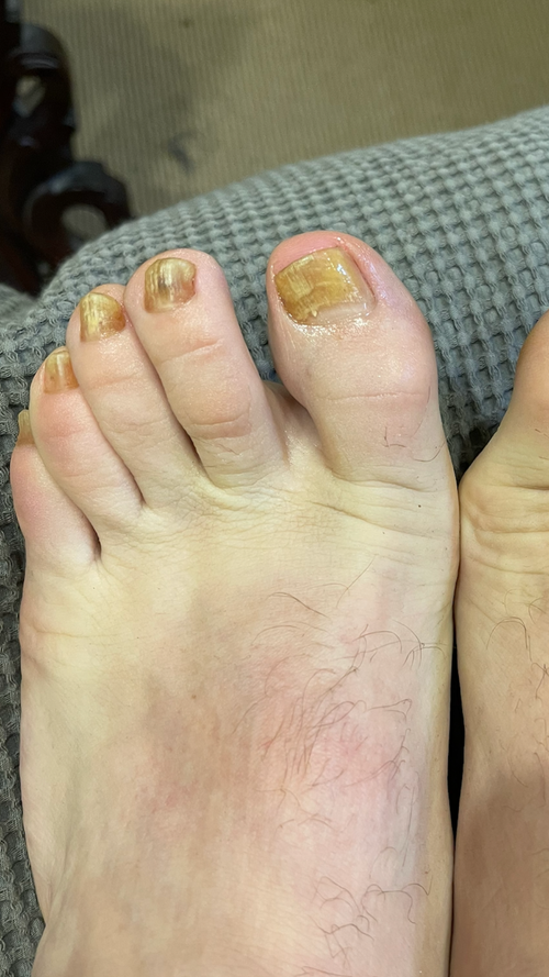 Before using FixaNail