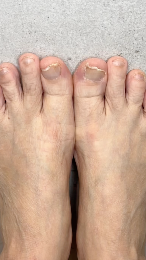 Before using FixaNail