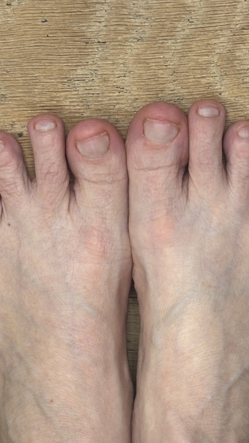 After using FixaNail