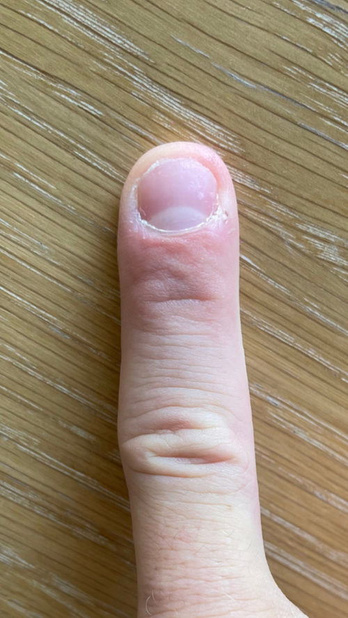 After using FixaNail