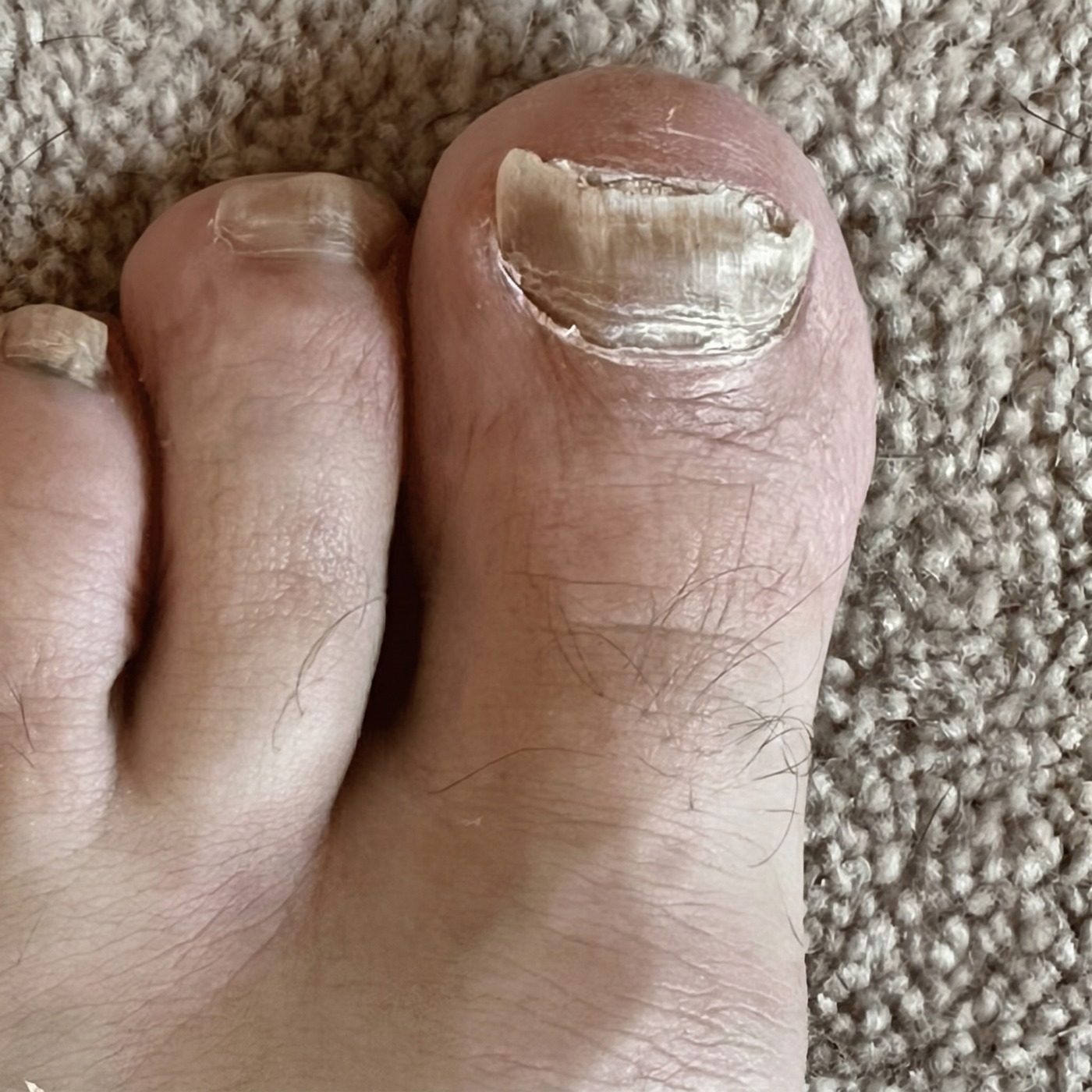 After using FixaNail