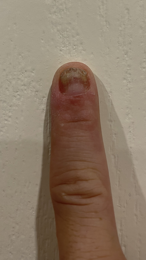 Before using FixaNail